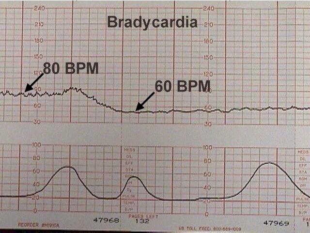 electronic-fetal-heart-monitoring